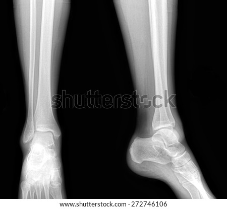 Real x-rays of the healthy lower leg (fibula) - front and side view