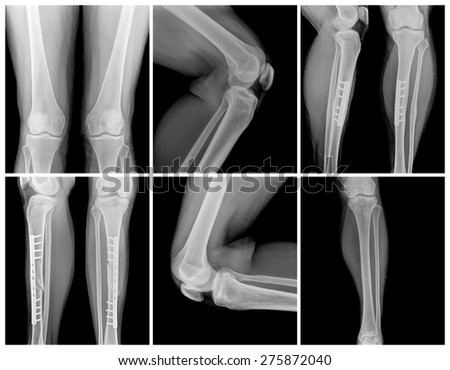 knee collection: x-ray of knee joint