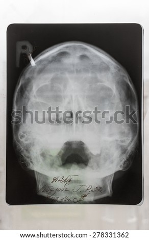 Closeup of a childs skull x-ray