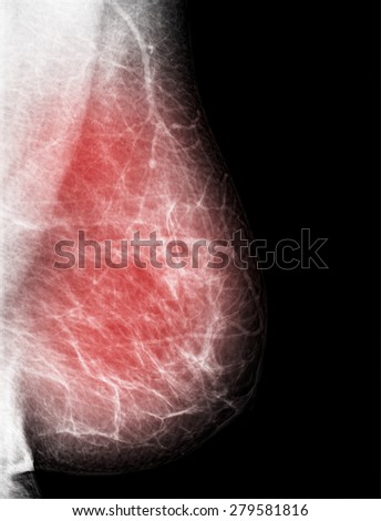 mammography x-ray picture