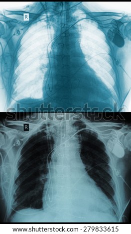 Chest X-ray picture negative positive
