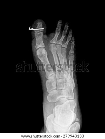 x-ray image of foot bone fracture