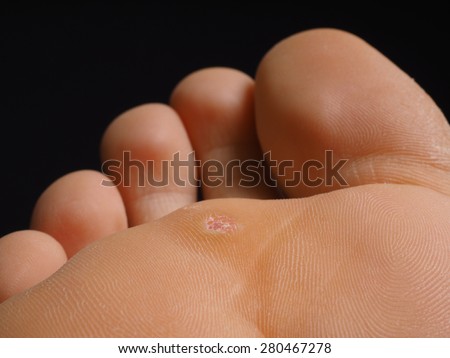 Closeup of foot with a infected wart placed under toes, isolated towards black Royalty-Free Stock Photo #280467278