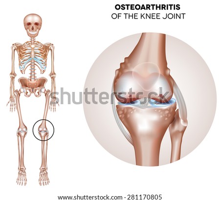 Arthritis of the knee joint, damaged joint cartilage and osteophytes.