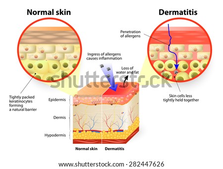 Atopic Dermatitis Cartoon Skin disease dermatitis or eczema Stock Photo 275935922 