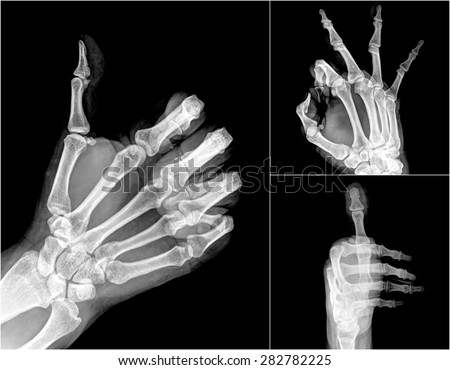 Collection X-ray symbol hands
