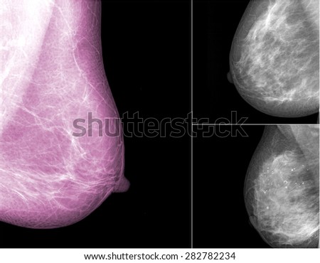 collection of Mammogram radio imaging for breast cancer 