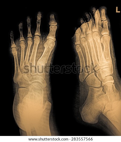 Colection x-ray of foot