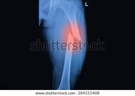 Fractured Femur, Broken thigh x-rays image Royalty-Free Stock Photo #284555408