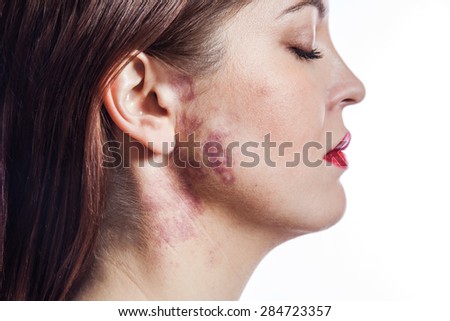 Beautiful woman with real port-wine stain (birthmark) on her face, isolated on white background. converted from raw and edited with special care.   