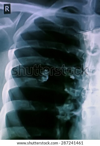 X-ray of the patient's pulmonary lung infection.