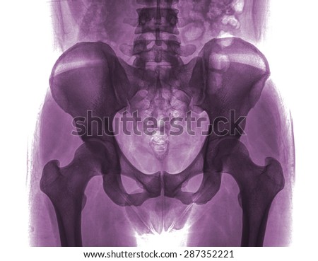 Rontgen picture of male pelvis