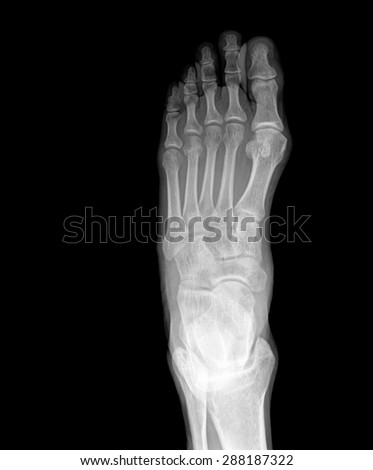 X-ray picture of foot , top view