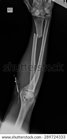 X-ray of both human arms.