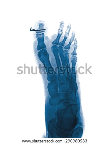 mammography x-ray picture ,isolated on white background