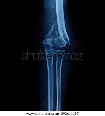 X-ray picture showing bone joints.