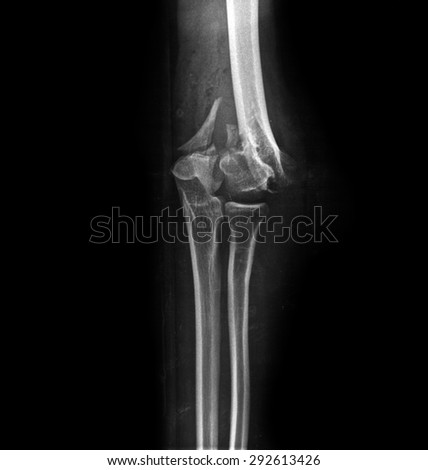 X-ray picture showing bone joints.