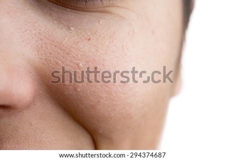 Milia (Plural milia) on face with space for your text. Royalty-Free Stock Photo #294374687