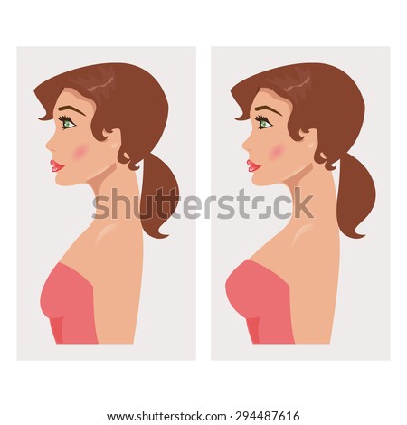 Illustration of a woman with breast before and after mammoplasty