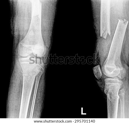 broken human thigh x-rays image ,Left leg fracture Royalty-Free Stock Photo #295701140