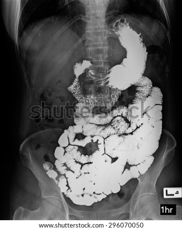 picture of intestinal abdominal xray