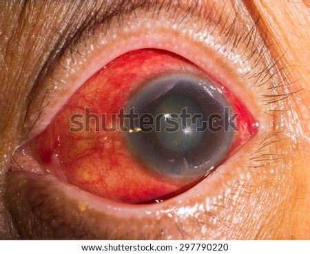 close up of the acute glaucoma during eye examination. Royalty-Free Stock Photo #297790220