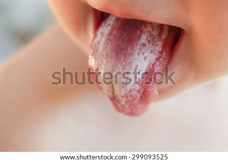 White coating on tongue baby. Oral thrush.  Royalty-Free Stock Photo #299093525