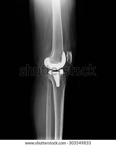 X-ray film of knee
