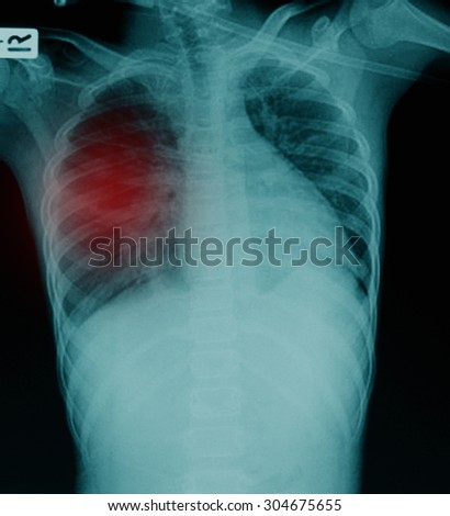 X-Ray Image Of Human Chest & Lung for a medical diagnosis