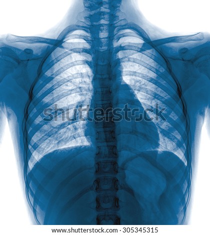 X-Ray Image Of  Chest for a medical diagnosis