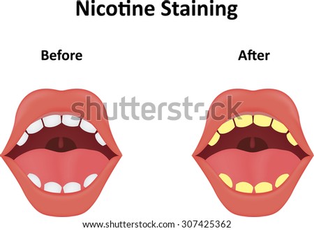 Nicotine Staining