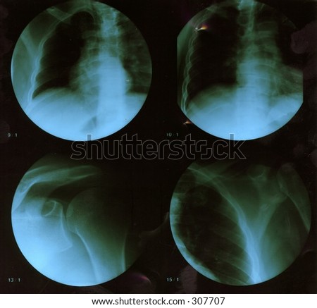 X-ray, röntgen picture.