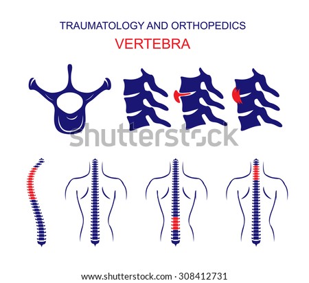 Illustration of the spine, vertebra, vertebral hernia, sprains, scoliosis. Schematic representation of back pain and back problems. Created for any specialized medical illustrations.