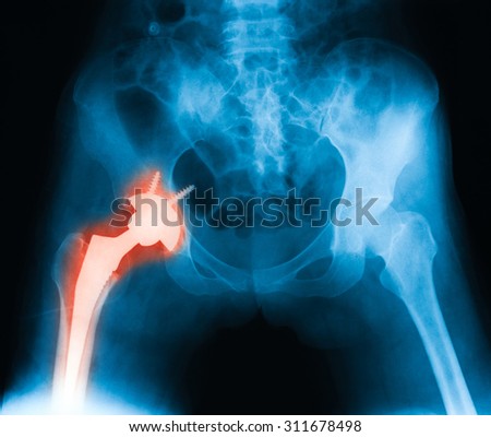 immediate postoperative x-ray image of both hip, anteroposterior view. Showing total hip prosthesis on right side. Royalty-Free Stock Photo #311678498