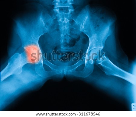 X-ray image of both hip, frog-leg Position, Showing right hip osteoarthritis. Royalty-Free Stock Photo #311678546