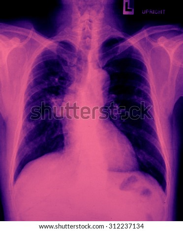 X-Ray Image Of Human Chest & Lung for a medical diagnosis