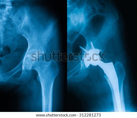 X-ray  of osteoarthritis (anteroposterior view), a 36 years old woman, preoperative (left) and immediate postoperative(right). Royalty-Free Stock Photo #312281273