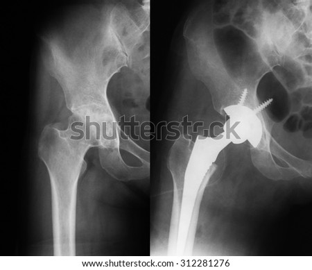 X-ray  of osteoarthritis (anteroposterior view), a 36 years old woman, preoperative (left) and immediate postoperative(right). Royalty-Free Stock Photo #312281276