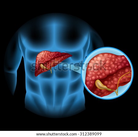 Sclerosis diagram in human body illustration