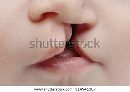 Baby with lip cleft, close-up on lips Royalty-Free Stock Photo #314941307