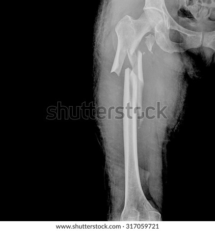 X-rays of leg broken