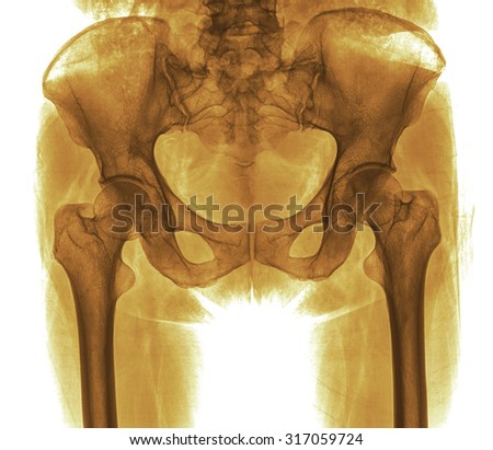 X-ray view of hip