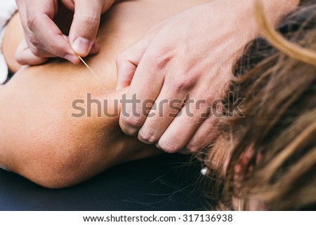 Physiotherapist doing a dry puncture Royalty-Free Stock Photo #317136938