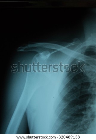 X-ray film image bony shoulders, shoulder disorders.