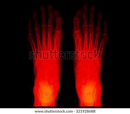 X-ray picture of foot.