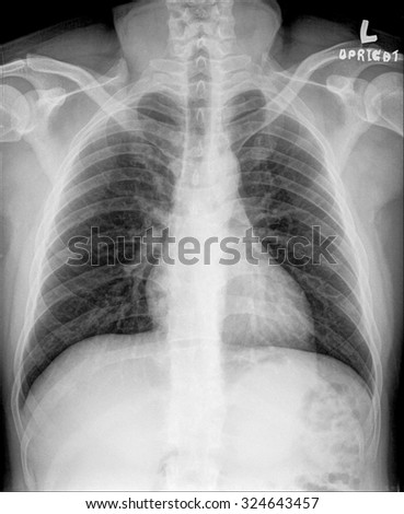 Medical X-rays , chest
