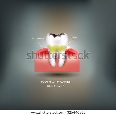 Dental caries and cavity, dental plaque with inflammation. Beautiful abstract mesh background