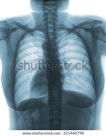 mammography x-ray picture , isolated on white background