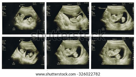 Compilation of six ultrasound scans of baby twins in utero at 12 weeks with scans of the twins together and seen separately  Royalty-Free Stock Photo #326022782