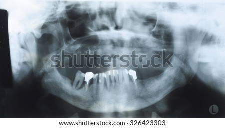 Panoramic dental x-ray of an old person with some lower teeth and no tooth of the upper Royalty-Free Stock Photo #326423303